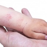 Dermatite atopica nei bambini: sintomi e cure