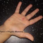 Varicella nei bambini: informazioni utili